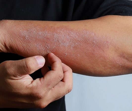 Egzama, yaygın olarak görülen kronik bir cilt hastalığı olup, milyonlarca insanı etkilemektedir. Tıp dilinde “atopik dermatit” olarak da adlandırılan bu durum, özellikle bağışıklık sisteminin aşırı reaksiyonu ile ilişkilidir. Cilt bariyerinin zayıflaması, çevresel etkenlere karşı hassasiyetin artması ve genetik yatkınlık egzamanın gelişiminde başlıca faktörlerdendir. Ancak en belirgin belirtisi kaşıntı, kuruluk ve kızarıklıkla kendini gösteren bir iltihaplanma sürecidir. Bu yazıda egzamanın ne olduğu, neden kaşıntıya yol açtığı ve Türkiye’deki yaygınlığı ele alınacaktır. Konulu bir haber görseli.