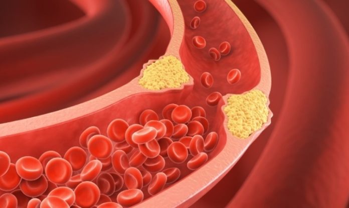 HDL ve LDL Kolesterol Ne Anlama Geliyor Kolesterol, vücutta bulunan ve vücudun birçok önemli işlevini sürdürebilmesi için gerekli olan bir yağ molekülüdür. Ancak, kolesterolün türü ve seviyeleri, sağlığımız üzerinde büyük bir etkiye sahiptir. Kolesterol seviyelerini değerlendiren önemli terimler arasında HDL ve LDL kolesterol yer alır. Bu iki terim, kalp sağlığı açısından kritik rol oynayan ve doktorların hastalarının kolesterol seviyelerini değerlendirmede kullandığı başlıca göstergelerdir. Bu yazıda, HDL ve LDL kolesterolün ne anlama geldiğini, bunların vücut üzerindeki etkilerini ve nasıl yönetilebileceğini inceleyeceğiz. Konulu bir haber görseli.