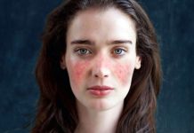 Lupus, bağışıklık sisteminin vücudun kendi dokularına karşı yanlışlıkla savaş açtığı otoimmün bir hastalık olarak bilinir. Bu hastalık özellikle genç kadınlarda görülür ve tüm dünyada milyonlarca insanı etkiler. Bağışıklık sistemi, normalde vücuda dışarıdan giren bakteri, virüs veya zararlı mikroorganizmalara karşı bir savunma mekanizması olarak çalışırken, lupus hastalığında bu sistem kendi organlarını hedef alır. Bu durum çeşitli organ ve dokularda iltihaplanma ve hasara neden olur. Konulu bir haber görseli