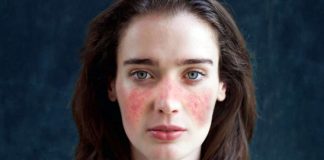 Lupus, bağışıklık sisteminin vücudun kendi dokularına karşı yanlışlıkla savaş açtığı otoimmün bir hastalık olarak bilinir. Bu hastalık özellikle genç kadınlarda görülür ve tüm dünyada milyonlarca insanı etkiler. Bağışıklık sistemi, normalde vücuda dışarıdan giren bakteri, virüs veya zararlı mikroorganizmalara karşı bir savunma mekanizması olarak çalışırken, lupus hastalığında bu sistem kendi organlarını hedef alır. Bu durum çeşitli organ ve dokularda iltihaplanma ve hasara neden olur. Konulu bir haber görseli