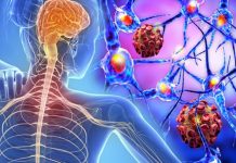 Multipl Skleroz (MS), merkezi sinir sistemini etkileyen ve bağışıklık sisteminin sinir hücrelerine zarar vermesiyle karakterize edilen kronik bir hastalıktır. Beyin ve omurilikteki sinir liflerinin etrafını saran miyelin kılıfının tahrip olmasıyla oluşan bu durum, bilgi akışının kesintiye uğramasına ve ciddi nörolojik sorunlara yol açar. Hastalık, genellikle genç erişkinlerde başlar ve yaşam boyu sürebilir. Erken tanı ve uygun tedaviyle hastalığın etkileri azaltılabilmektedir. Konulu bir haber görseli.