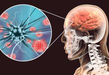 Menenjit, beyin ve omuriliği çevreleyen zarların iltihaplanmasıyla oluşan bir hastalıktır. Bu durum, genellikle bakteriyel, virüs veya fungal enfeksiyonlar sonucunda meydana gelir ve hayati tehlike oluşturabilecek bir sağlık sorunu olarak kabul edilir. Menenjit belirtileri hızla ortaya çıkabileceği için erken tanı ve tedavi büyük önem taşır. Bu yazıda, menenjitin ne olduğunu, belirtilerini, nasıl teşhis edilebileceğini ve erken tanının neden bu kadar kritik olduğunu ele alacağız. Konulu bir haber görseli.