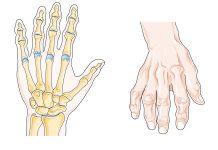 Romatoid artrit, vücudun bağışıklık sisteminin kendi dokularına saldırmasıyla oluşan kronik ve ilerleyici bir eklem hastalığıdır. Bu hastalık, özellikle küçük eklemleri hedef alır ve zamanla iltihap, şişlik, hareket kısıtlılığı ve ağrıya neden olur. Romatoid artrit, diğer artrit türlerinden farklı olarak hem eklemlerde hem de tüm vücutta yorgunluk, halsizlik gibi sistemik belirtiler gösterebilir. Kadınlarda erkeklere oranla daha sık görülür ve genellikle 30 ila 60 yaş arasında başlar. Konulu bir haber görseli.