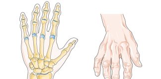 Romatoid artrit, vücudun bağışıklık sisteminin kendi dokularına saldırmasıyla oluşan kronik ve ilerleyici bir eklem hastalığıdır. Bu hastalık, özellikle küçük eklemleri hedef alır ve zamanla iltihap, şişlik, hareket kısıtlılığı ve ağrıya neden olur. Romatoid artrit, diğer artrit türlerinden farklı olarak hem eklemlerde hem de tüm vücutta yorgunluk, halsizlik gibi sistemik belirtiler gösterebilir. Kadınlarda erkeklere oranla daha sık görülür ve genellikle 30 ila 60 yaş arasında başlar. Konulu bir haber görseli.
