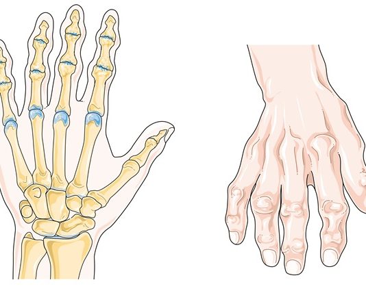 Romatoid artrit, vücudun bağışıklık sisteminin kendi dokularına saldırmasıyla oluşan kronik ve ilerleyici bir eklem hastalığıdır. Bu hastalık, özellikle küçük eklemleri hedef alır ve zamanla iltihap, şişlik, hareket kısıtlılığı ve ağrıya neden olur. Romatoid artrit, diğer artrit türlerinden farklı olarak hem eklemlerde hem de tüm vücutta yorgunluk, halsizlik gibi sistemik belirtiler gösterebilir. Kadınlarda erkeklere oranla daha sık görülür ve genellikle 30 ila 60 yaş arasında başlar. Konulu bir haber görseli.