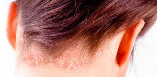Sedef hastalığı, tıbbi adıyla psoriasis, bağışıklık sisteminin yanlış sinyaller göndermesi sonucu deride meydana gelen kronik ve iltihaplı bir cilt hastalığıdır. Her yaş grubunda görülebilmekle birlikte genellikle genç erişkinlik döneminde ortaya çıkar. Toplumun yaklaşık %2 ila %3’lük bir kesimini etkileyen bu hastalık, kişiden kişiye farklılık gösteren klinik belirtilerle seyredebilir. Ancak pek çok hasta ve hasta yakını, en çok "sedef hastalığı deride kalıcı iz bırakır mı?" sorusunun cevabını merak etmektedir. Bu haberimizde, sedef hastalığının neden olduğu deri lezyonlarının iyileşme sürecinden, iz bırakma olasılığına kadar birçok detaya yer veriyoruz. Konulu bir haber görseli.