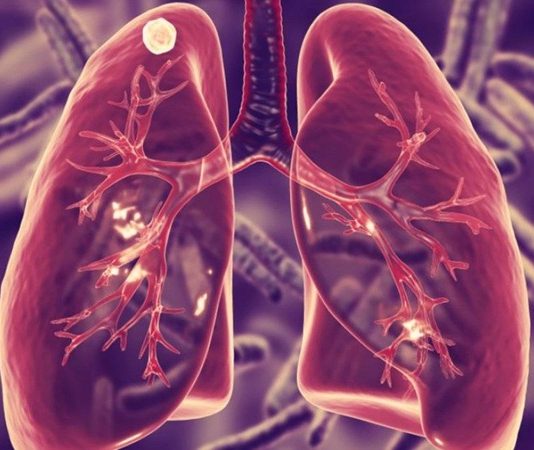 Tüberküloz, dünya genelinde milyonlarca insanı etkileyen bulaşıcı ve ciddi bir solunum yolu hastalığıdır. En çok akciğerleri tutsa da, vücudun farklı bölgelerinde de hastalığa yol açabilir. Özellikle gelişmekte olan ülkelerde yaygın olan bu hastalık, sağlık sistemleri üzerinde önemli bir yük oluşturmaktadır. Halk arasında “verem” olarak da bilinen tüberküloz, geçmişte ölümcül sonuçlara neden olmuş, ancak günümüzde erken tanı ve tedavi ile büyük ölçüde kontrol altına alınabilir hale gelmiştir. Konulu bir haber görseli.