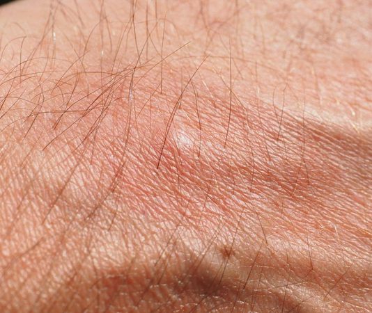 Uyuz hastalığı, insan cildinde yoğun kaşıntıya neden olan bulaşıcı bir deri enfeksiyonudur. Sarcoptes scabiei adlı mikroskobik bir akarın cilde yerleşmesiyle ortaya çıkan bu hastalık, özellikle kalabalık ortamlarda hızla yayılabilir. Akarın deriye girerek tüneller açması sonucu oluşan reaksiyonlar, şiddetli kaşıntı ve döküntü gibi belirtilerle kendini gösterir. Uyuz, sadece fiziksel rahatsızlık vermekle kalmaz, aynı zamanda sosyal ve psikolojik etkiler de yaratabilir. Bu nedenle uyuz hastalığı hakkında bilinçli olmak, erken teşhis ve etkili tedavi için oldukça önemlidir. Konulu bir haber görseli.