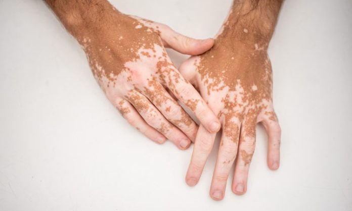 Vitiligo Nedir Ciltteki Beyaz Lekeler Ne Anlama Gelir Vitiligo, ciltteki melanin pigmentinin kaybı sonucu ortaya çıkan bir cilt hastalığıdır. Bu durum, genellikle açık beyaz renkte yamalar şeklinde belirir ve farklı boyutlarda olabilir. Özellikle yüz, el, kol, bacak gibi vücudun açıkta kalan bölgelerinde daha belirgin hale gelir. Genetik yatkınlıkla bağlantılı olabileceği gibi bağışıklık sistemiyle ilgili bozukluklar da hastalığın ortaya çıkmasında etkili olabilir. Her ne kadar vitiligo doğrudan fiziksel bir ağrıya yol açmasa da, sosyal ve psikolojik etkileri oldukça derin olabilir. Bu nedenle hem hastalığın tanımı hem de neden oluştuğu, kimlerde görüldüğü gibi konular kamuoyunun sıkça merak ettiği başlıklardan biridir. Konulu bir haber görseli.